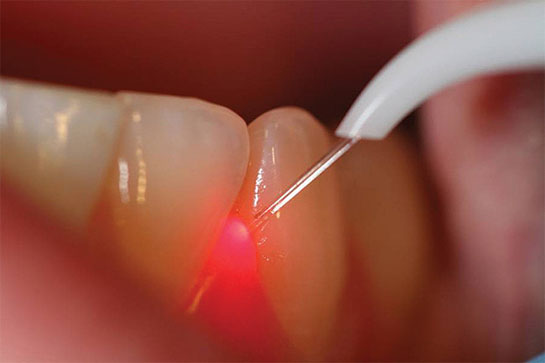 laser dentistry